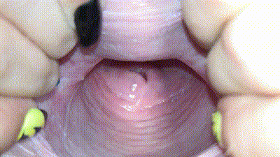 图片[5]-【内窥】探秘阴道子宫深处 阴道内窥集合【80V 8.78G】【PK】 • 欲泽社 - 全网每日精品资源-欲泽社 - 全网每日精品资源